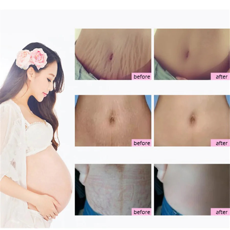 Mango Antenatal Cream - RtopR Body Cream