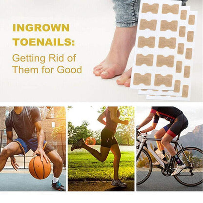 50-100Pcs Glue Free Toenail Toe Ingrown Nail Correction Patch Sticker Foot Care-3