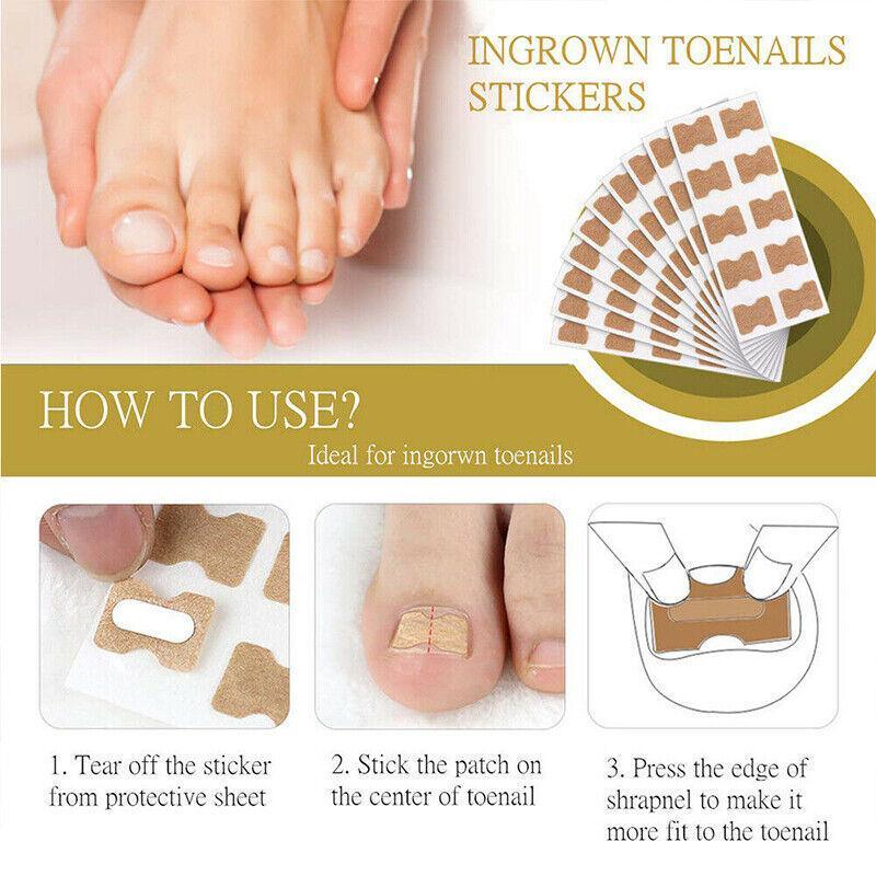 50-100Pcs Glue Free Toenail Toe Ingrown Nail Correction Patch Sticker Foot Care-4