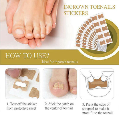 50-100Pcs Glue Free Toenail Toe Ingrown Nail Correction Patch Sticker Foot Care-4