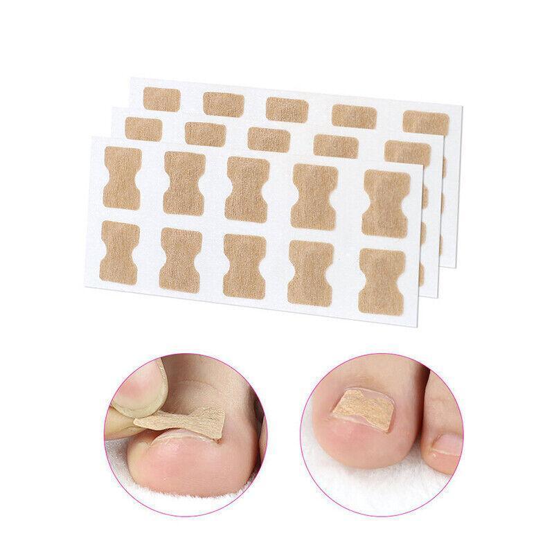 50-100Pcs Glue Free Toenail Toe Ingrown Nail Correction Patch Sticker Foot Care-2